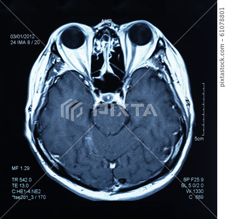 mri scan brain mri scan brain 61078801