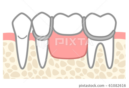 Partial denture illustration without tooth color 61082616