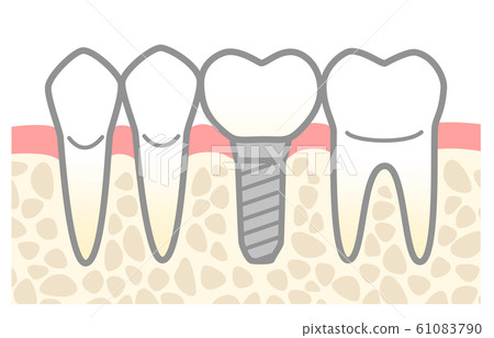 植入物圖 植入物圖 61083790