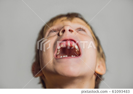 Abnormal boy tooth. The extra narrow strange tooth grew in the boy's mouth. Boy shows his crooked 61093483