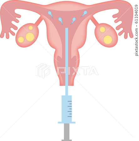 子宮_人工授精 61104019