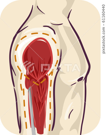 Man Muscle Atrophy Illustration Man Muscle Atrophy Illustration 61160440