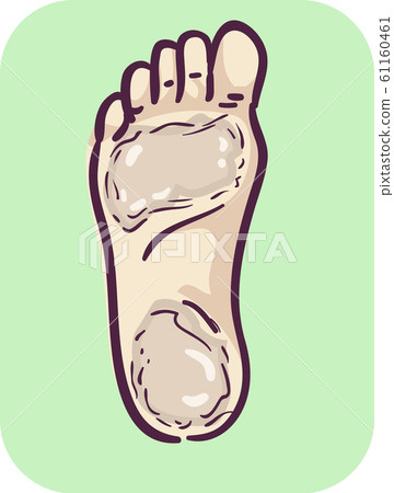 Foot Symptom Thicken Skin Illustration 61160461