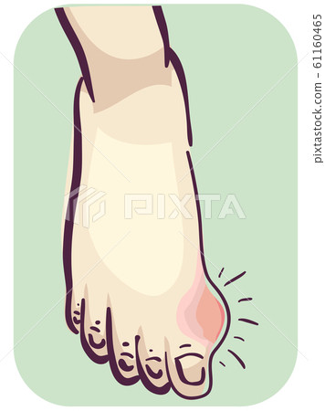 Foot with Gout Foot with Gout 61160465