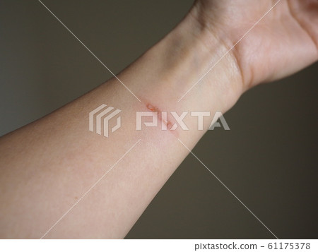 燒傷的手臂，在廚房裡用平底鍋燒傷的特寫照片 61175378