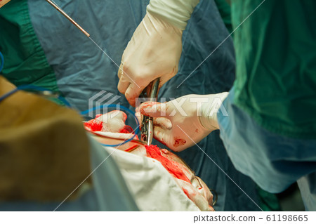 Operation of trepanation of the skull. 61198665