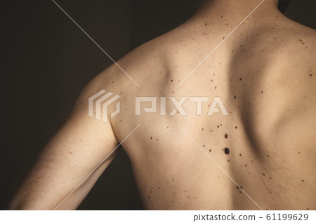 Moles on the back of a man. 61199629