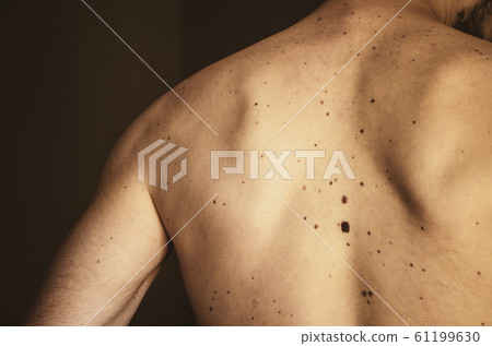 Moles on the back of a man. 61199630