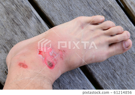 Closeup human foot with fresh wound Closeup human foot with fresh wound 61214856