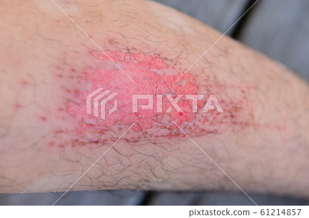 Closeup human legs with fresh wound 61214857