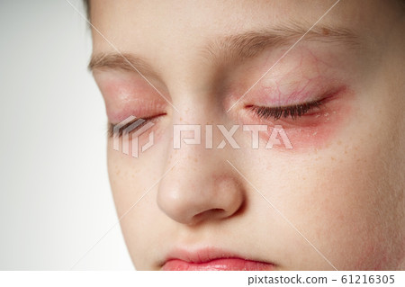 Allergic reaction, skin rash, close view portrait Allergic reaction, skin rash, close view portrait 61216305
