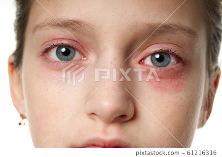 Allergic reaction, skin rash, close view portrait Allergic reaction, skin rash, close view portrait 61216316