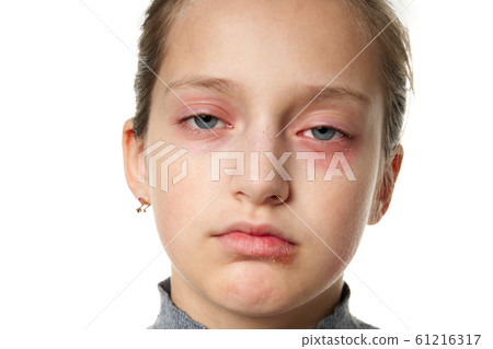 Allergic reaction, skin rash, close view portrait 61216317