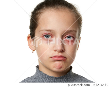 Allergic reaction, skin rash, close view portrait Allergic reaction, skin rash, close view portrait 61216319