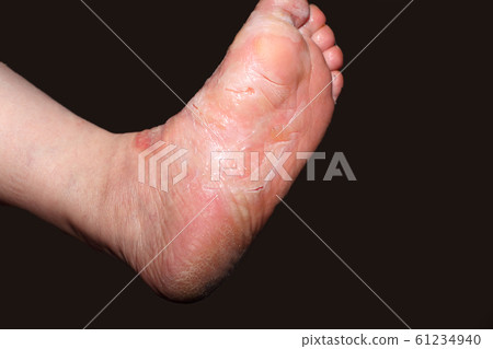 Burn, Ⅱ degree burn Burn, Ⅱ degree burn 61234940