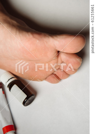 Fungus Infection on Nails of Man's Foot on white background.dermatitis on foot, athlete's foot disease Fungus Infection on Nails of Man's Foot on white background.dermatitis on foot, athlete's foot disease 61255661