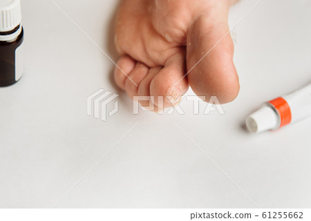 Fungus Infection on Nails of Man's Foot on white background.dermatitis on foot, athlete's foot disease Fungus Infection on Nails of Man's Foot on white background.dermatitis on foot, athlete's foot disease 61255662