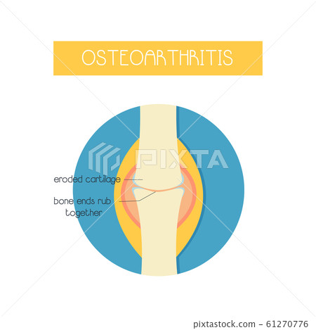 vector illustration of a bone with osteoarthritis 61270776