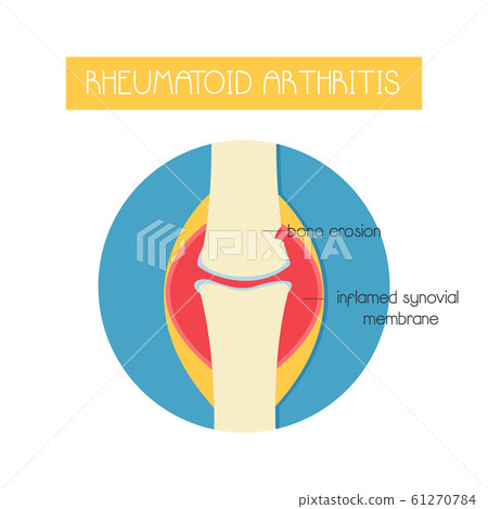 Illustration of a bone with rheumatoid arthritis. 61270784