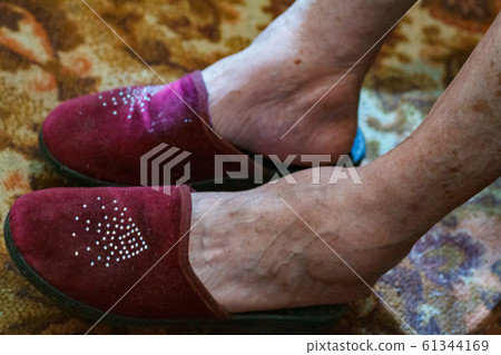 closeup feet of old an suffering from leprosy 61344169