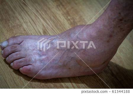 closeup feet of old an suffering from leprosy closeup feet of old an suffering from leprosy 61344188