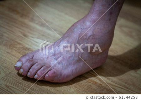 closeup feet of old an suffering from leprosy closeup feet of old an suffering from leprosy 61344258