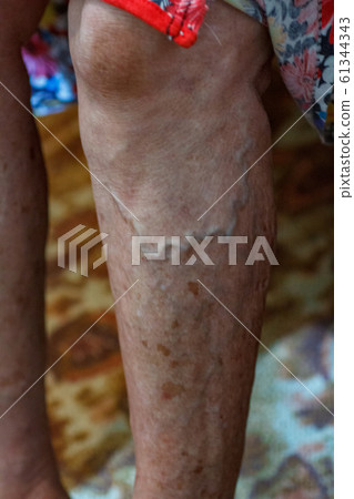 closeup feet of old an suffering from leprosy 61344343