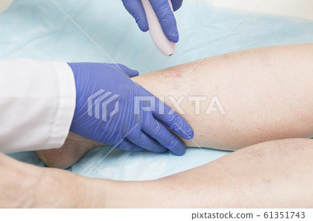 Specialist doctor conducts endovenous laser coagulation of the veins of the lower extremities. The concept of treatment for varicose veins and thrombosis Specialist doctor conducts endovenous laser coagulation of the veins of the lower extremities. The concept of treatment for varicose veins and thrombosis 61351743