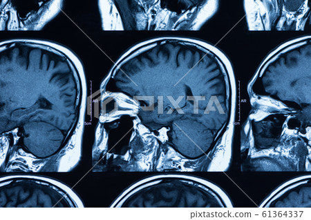 brain ct scan 61364337