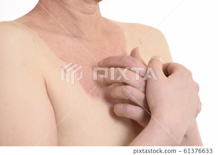 Japanese woman with skin disease Japanese woman with skin disease 61376633