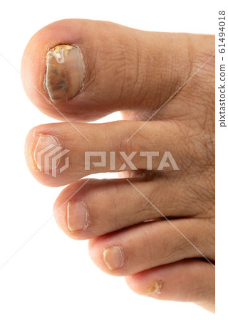 Nail athlete's foot 61494018