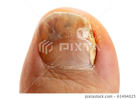 Big toe with athlete's foot 61494025