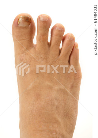 Nail athlete's foot 61494033