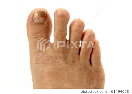 Nail athlete's foot Nail athlete's foot 61494038