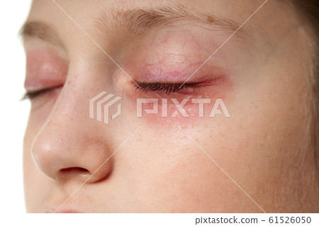 Allergic reaction, skin rash, close view portrait 61526050