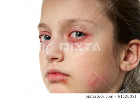 Allergic reaction, skin rash, close view portrait 61526051