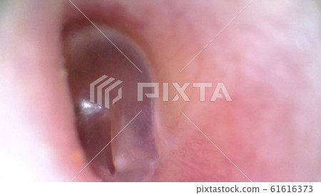 Tympanic membrane taken with an endoscope Tympanic membrane taken with an endoscope 61616373