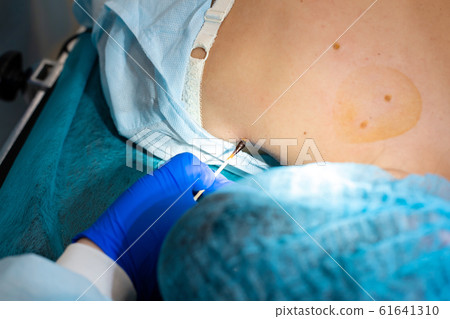 Close-up surgeon burns a mole on the back of the Close-up surgeon burns a mole on the back of the 61641310