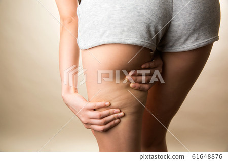 Thigh cellulite / young woman 61648876