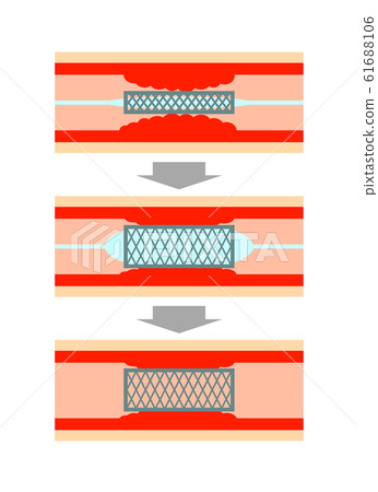 Vascular stent treatment 61688106