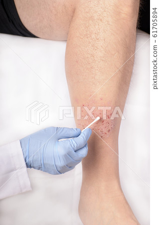 nurse's hands healing a painful eczema on a nurse's hands healing a painful eczema on a 61705894