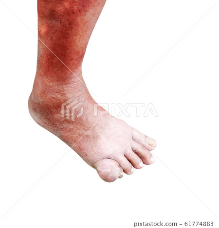 gout disease at foot on white background 61774883