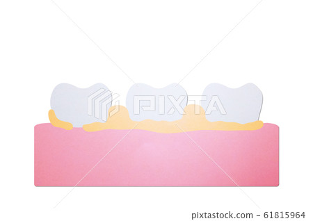 plaque or tartar, cause of tooth periodontal disease plaque or tartar, cause of tooth periodontal disease 61815964