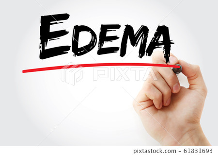 Edema text with marker 61831693