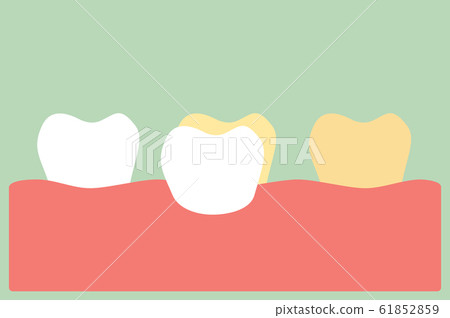 dental veneers installation procedure for tooth whiten dental veneers installation procedure for tooth whiten 61852859