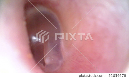 Tympanic membrane taken with an endoscope 61854676