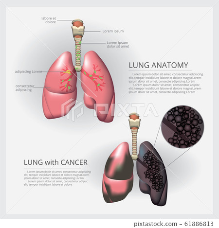 Lung with Detail and Lung Cancer Vector Illustration 61886813