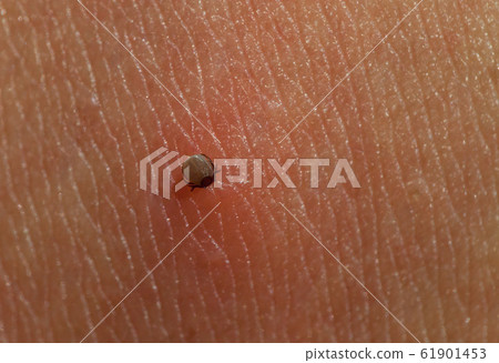 Small Tick on human skin sucking blood 61901453