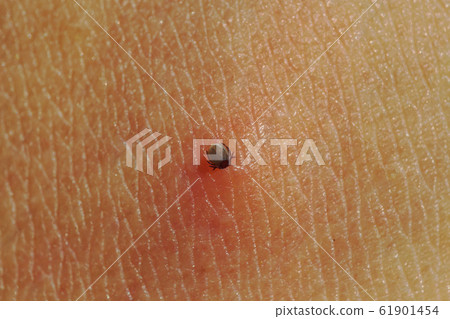 Small Tick on human skin sucking blood Small Tick on human skin sucking blood 61901454