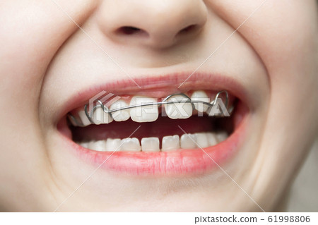 A girl with a removable orthodontic appliance. A 61998806